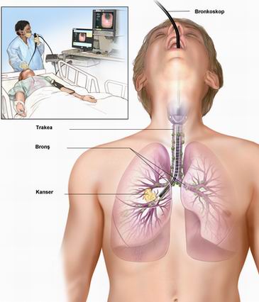 Akciğer Kanseri - Muayene Yöntemleri
