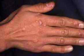 Siğiller Ve Rehabilitasyonları